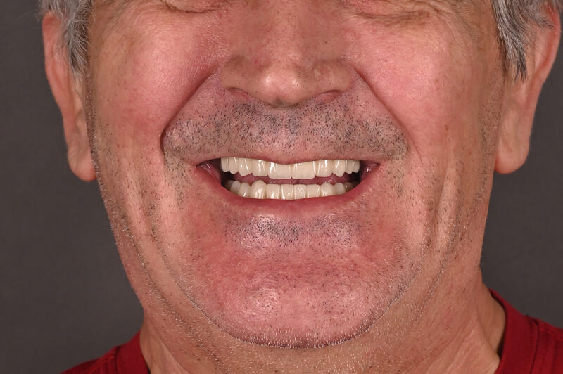 Zâmbet lateral stanga_dupa